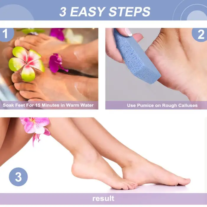 7_compressed Exfoliate Feet Pedicure Handle Pumice Stone Scraper Foot File Dead Hard Rough Dry Skin Scrub Callus Remover Manual Cracked Heels Yao Store - Image 1